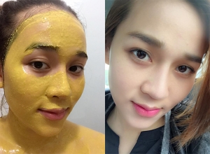 Bí quyết trị nám da bằng tinh bột nghệ đơn giản mà cực hiệu quả tại nhà